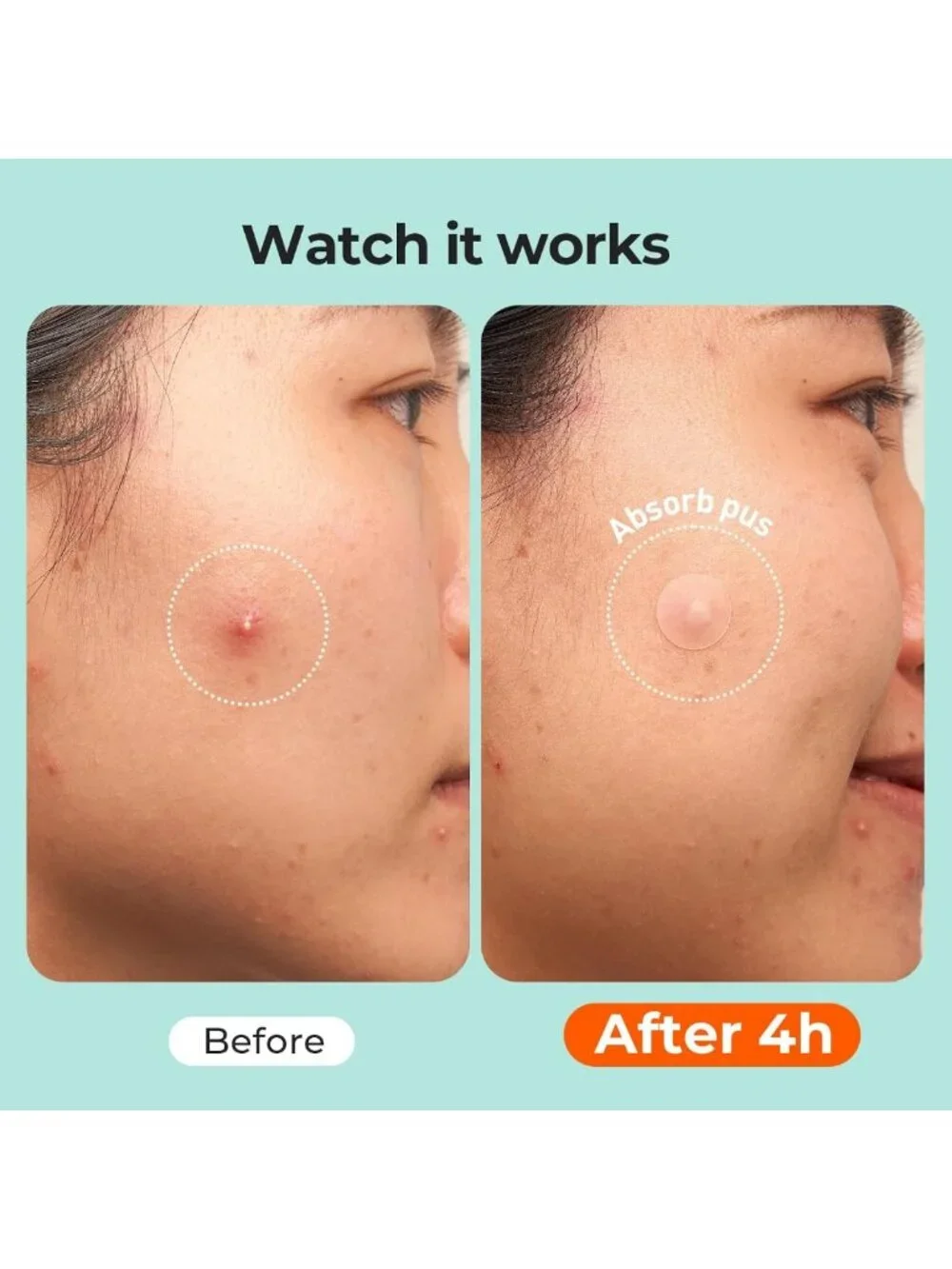 Hydrocolloid Acne Pimple Patches - 443 Count Face Cover for Clear Skin